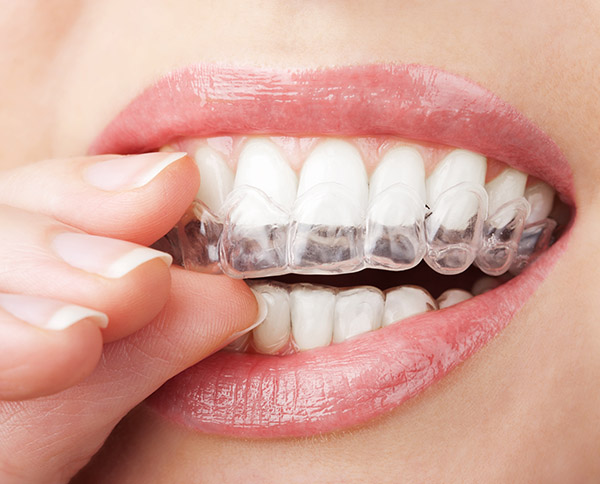 FAQs About Invisalign Treatment