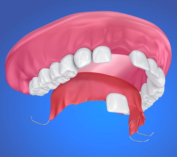 West Palm Beach Partial Denture for One Missing Tooth