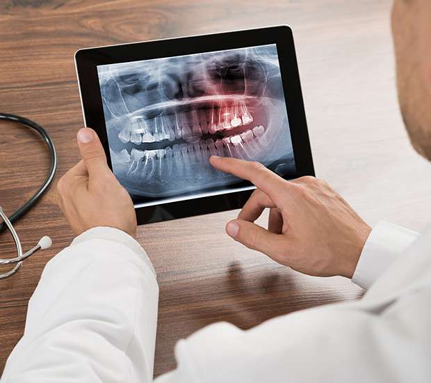 West Palm Beach Types of Dental Root Fractures
